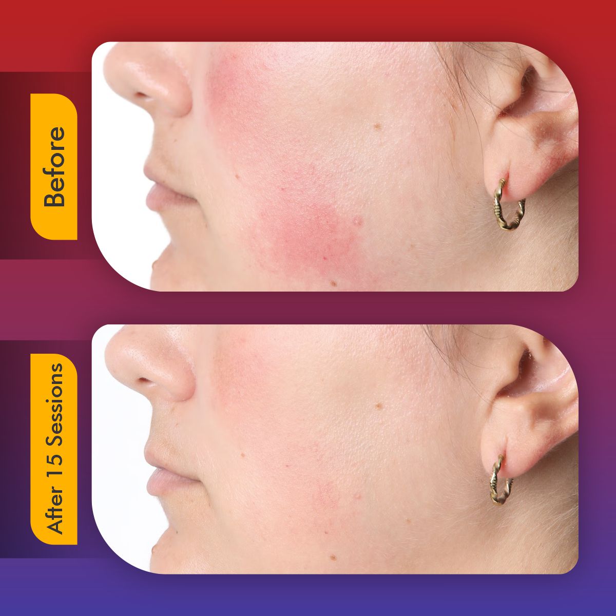 LED Facial Mask | Red Light Therapy