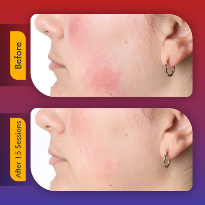 AuraGlow™ | LED Face Mask